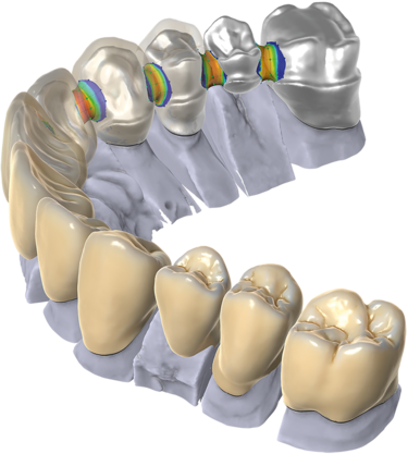 Exocad Dental Model